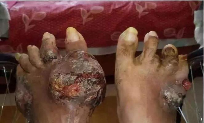 狗狗患上痛风，如何治疗？（探讨狗狗患上痛风的原因和治疗方法）