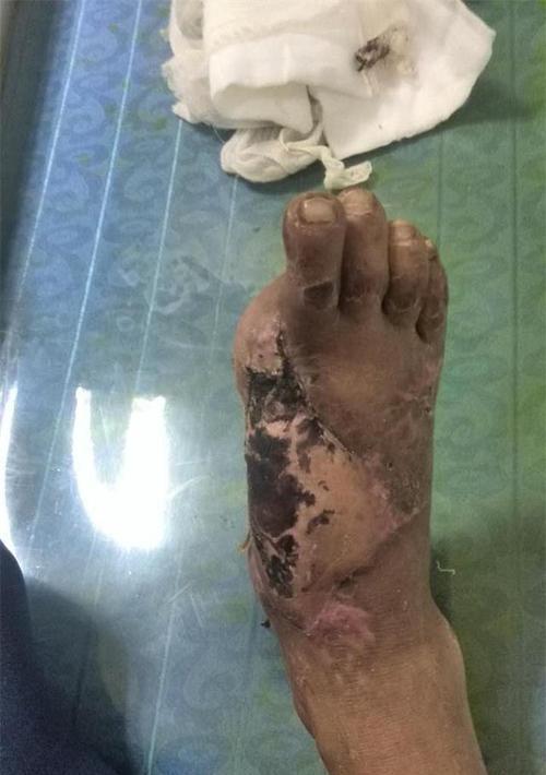 狗狗折断肢骨的处理方法（宠物主人必看，教你如何应对狗狗骨折）