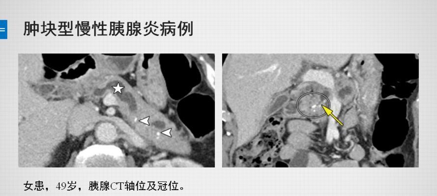 圣伯纳犬胰脏炎，从预防到治疗（了解胰脏炎的症状，保护你的爱宠健康）