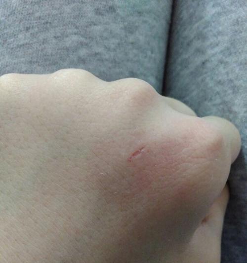 狗狗被咬伤了怎么办？——宠物主人必看的处理方法