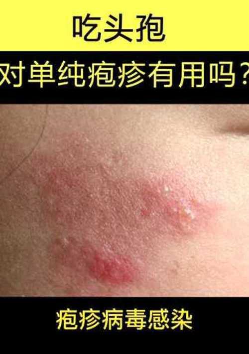 以狗打头孢的副作用及注意事项（了解以狗打头孢治疗时的潜在风险及注意事项）